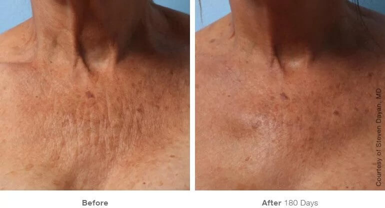 Ultherapy Chest Vancouver | Before & After | EverYoung Skin Clinic