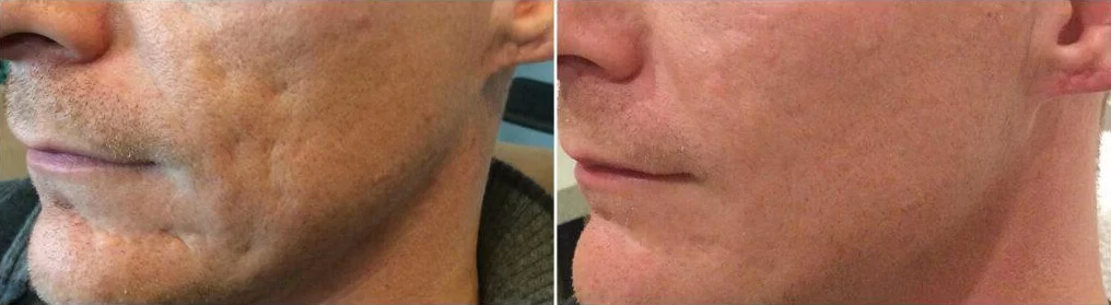 BELLAFILL Acne Scar Treatment Vancouver | EverYoung Skin Clinic