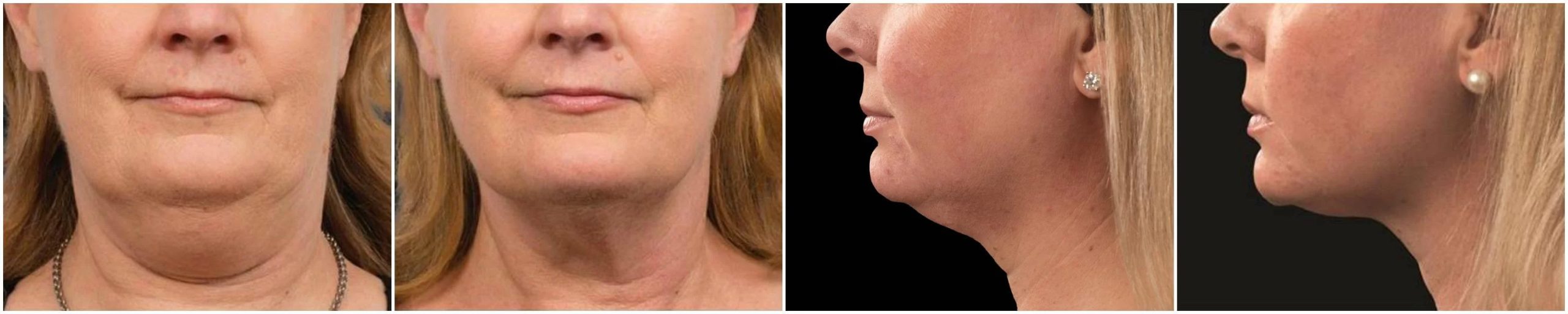 Coolsculpting Double Chin Removal | Before & After Treatment | EverYoung Skin Care Clinic