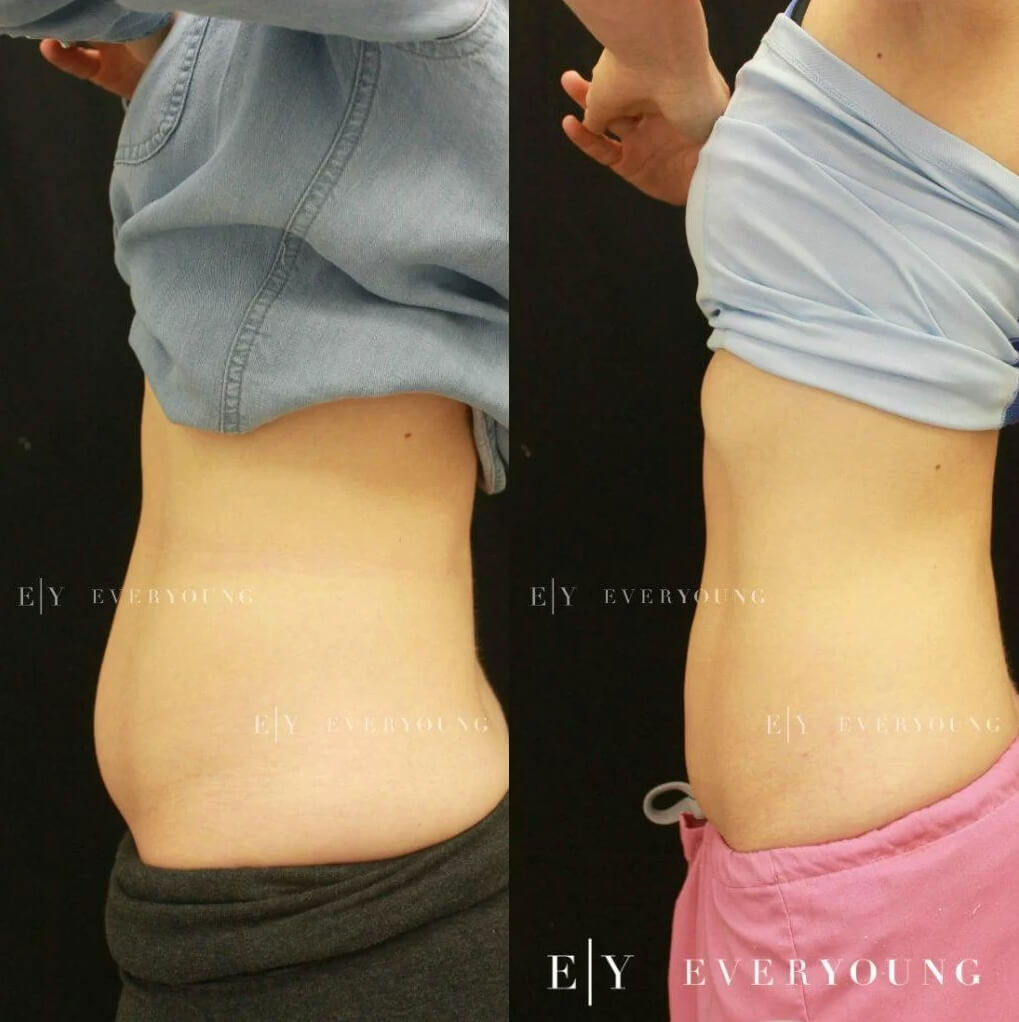 Coolsculpting - Before & After | EverYoung Skin Clinic Vancouver