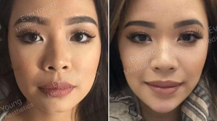 Facial Slimming with Botox Vancouver | EverYoung Skin Clinic