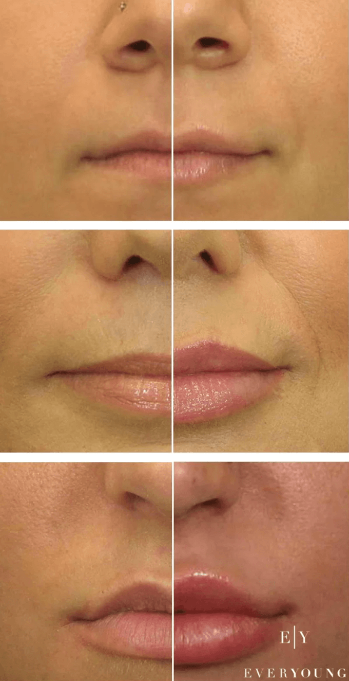 Lip Fillers Examples in Vancouver | EverYoung Skin Care Clinic