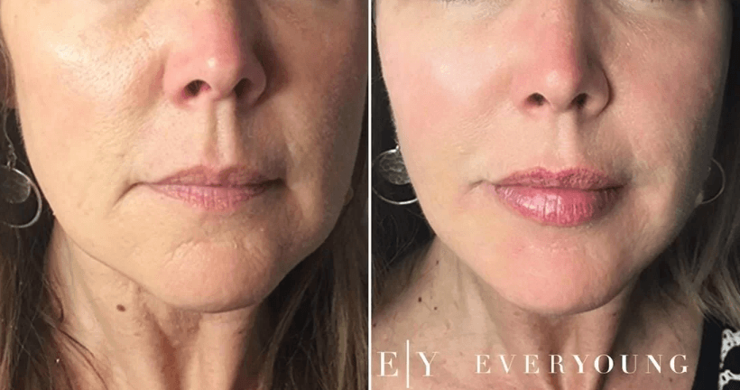 Actual EverYoung patient / Cheek, Jawline and Lip Enhancement | EverYoung Skin Clinic