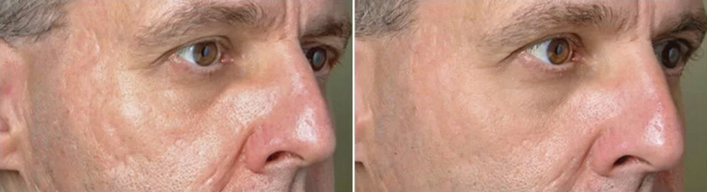 PROFRACTIONAL Laser Skin Resurfacing Vancouver | EverYoung Skin Clinic