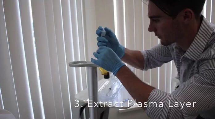 Step 3: Extract Plasma Layer | EverYoung Skin Clinic Vancouver