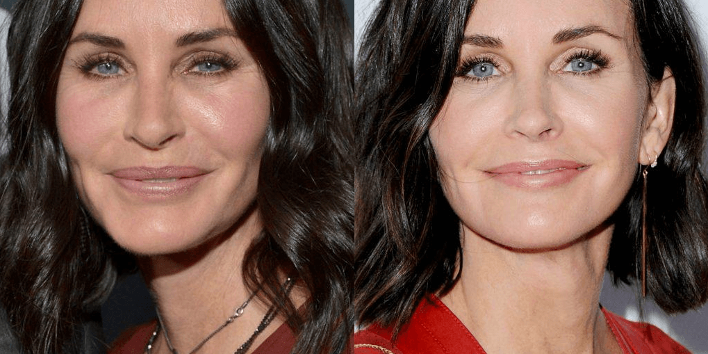 Too Much Fillers on Courtney Cox | EverYoung Skin Clinic Vancouver