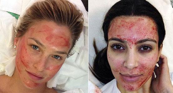 Bar Refaeli and Kim Kardashian are fans of the Vampire Facelift | EverYoung Skin Care Clinic