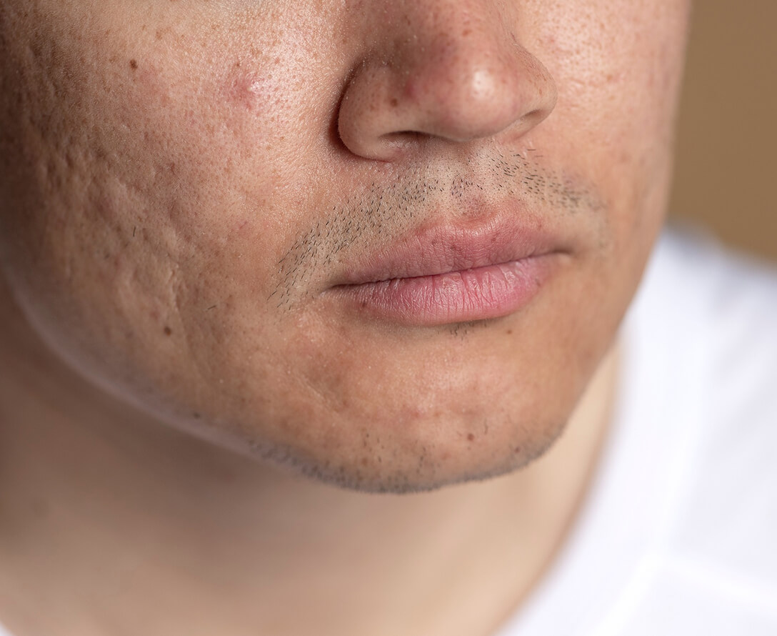 Acne & Facial Scars and How to Treat Them | EverYoung Skin Clinic Vancouver