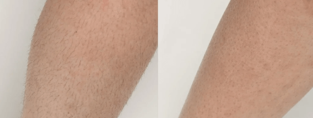 Which Areas of the Body Can You Receive Laser Hair Removal? | EverYoung Skin Clinic Vancouver