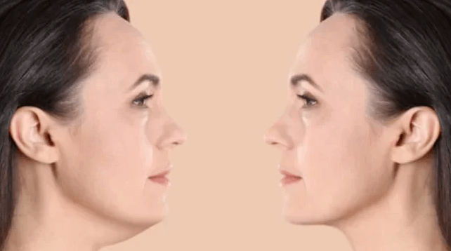 Belkyra Double Chin Reduction | EverYoung Skin Care Clinic Vancouver