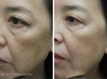 Better Skin Before & After | EverYoung Skin Care Clinic Vancouver