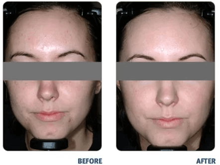 BLU U Acne Therapy | Before & After Therapy | EverYoung Skin Care Clinic Vancouver