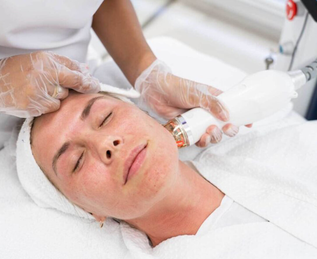 Does Secret RF Microneedling Work? Everything You Need to Know About This Skin Treatment | EverYoung Skin Clinic Vancouver