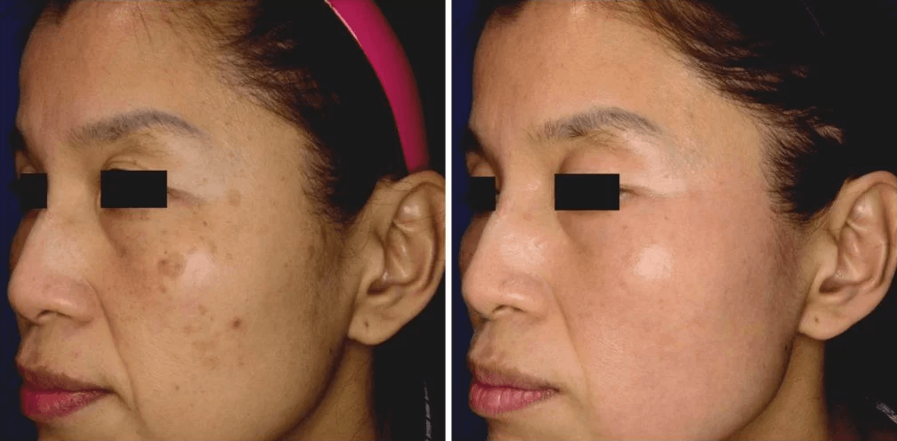 Pigmented lesions before and after a series of treatments with the PicoSure Focus Laser | EverYoung