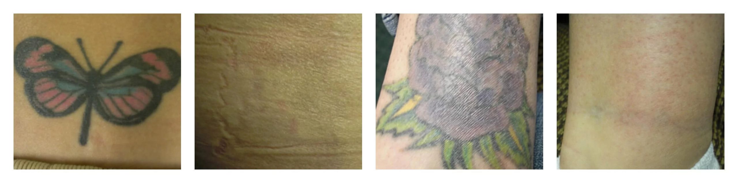 Tattoo Removal - Before & After | EverYoung Skin Clinic Vancouver