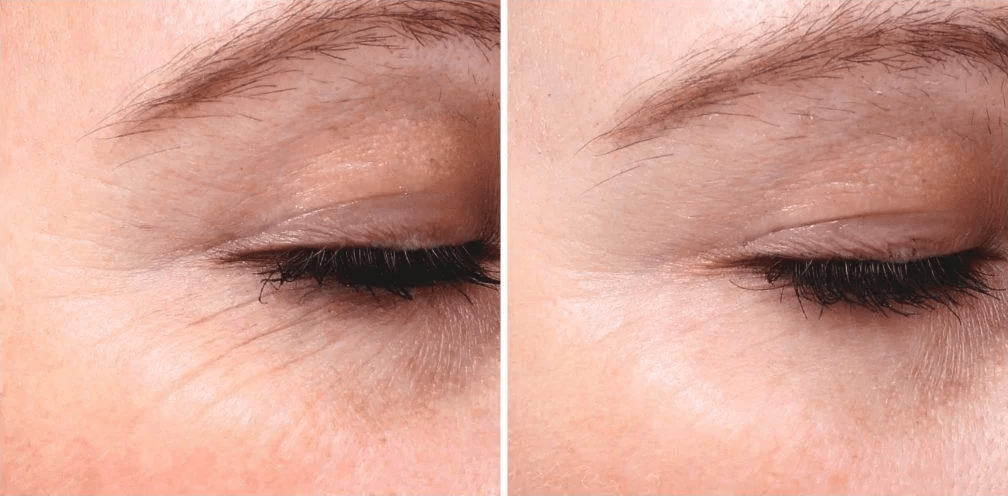 Wrinkle reduction and softening of crow’s feet with PicoSure Focus Laser | EverYoung
