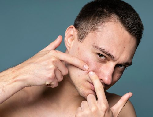 Exploring Blue Light Therapy for Acne