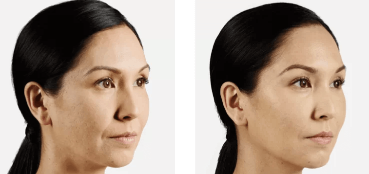 Fillers Vancouver | Before & After | EverYoung Skin Clinic Vancouver