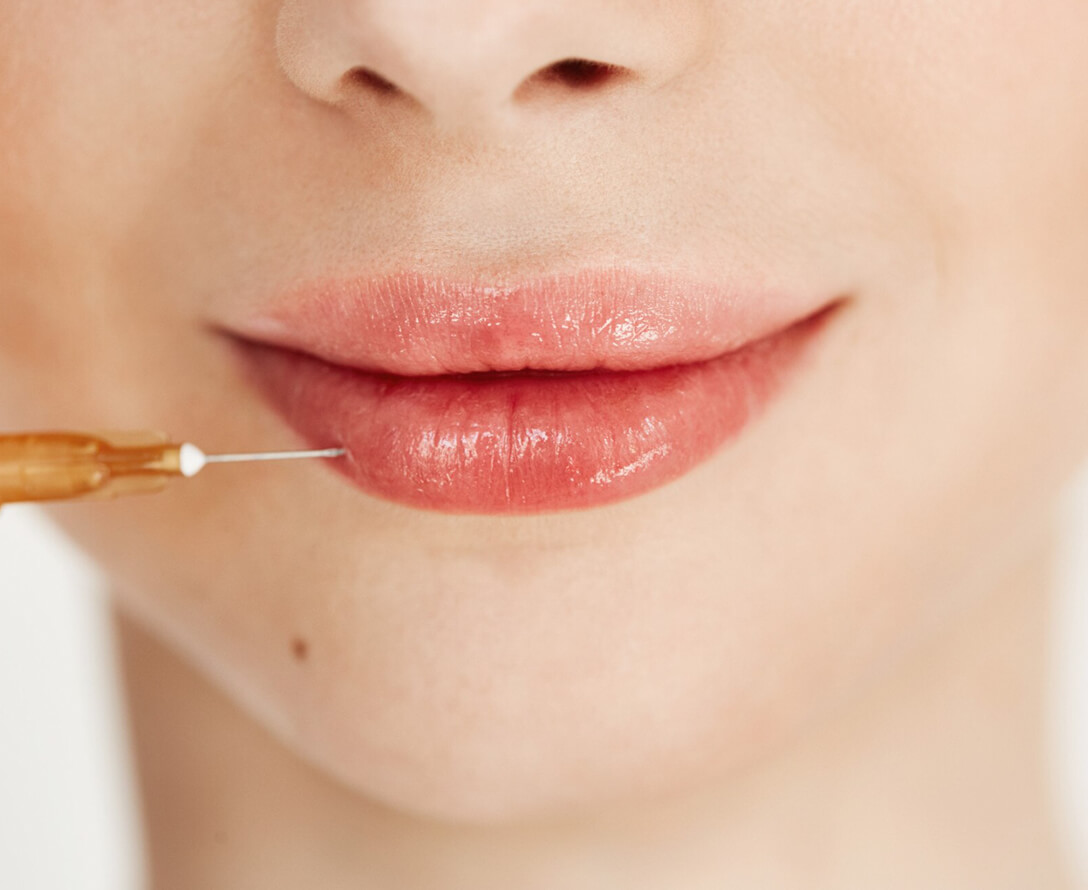 Fillers Do's and Don'ts | EverYoung Skin Care Clinic Vancouver
