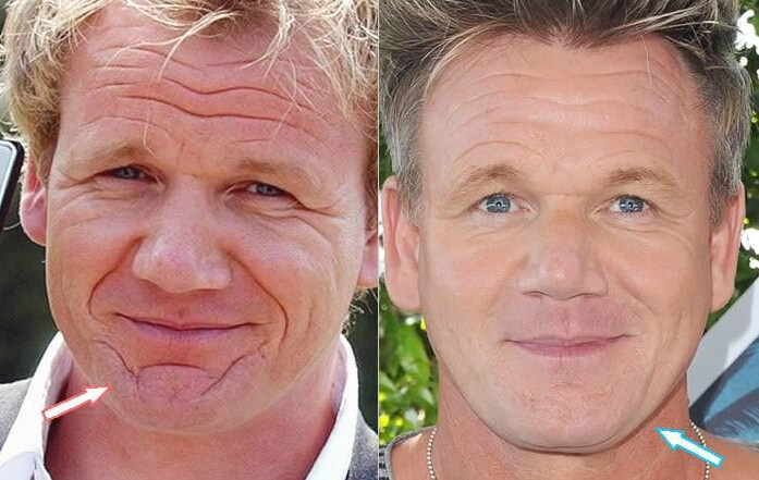 Gordon Ramsay Chin Scars | EverYoung Skin Clinic Vancouver
