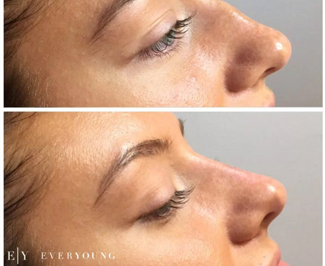 Rhinoplasty Before & After | EverYoung Skin Care Clinic Vancouver