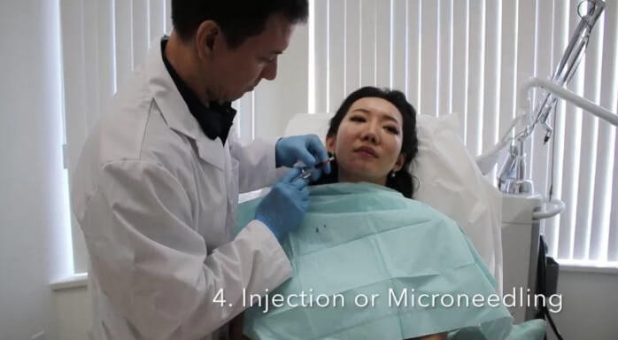 Step 4: Injection Microneedling | EverYoung Skin Clinic Vancouver