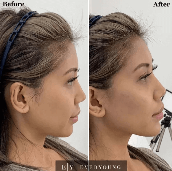 Jawline Fillers Vancouver | Before & After | EverYoung Skin Clinic