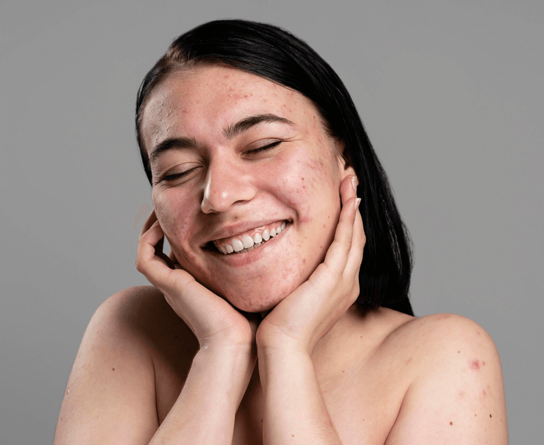 Long Lasting Fillers and Bellafill | EverYoung Skin Care Clinic Vancouver