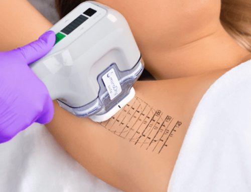 MiraDry or Botox? Which Treatment is Best for Underarm Sweating?