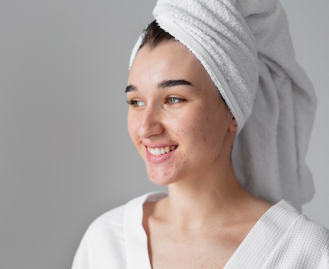 Overcoming Acne Scars: Treatment Options & Results | EverYoung Skin Care Clinic Vancouver