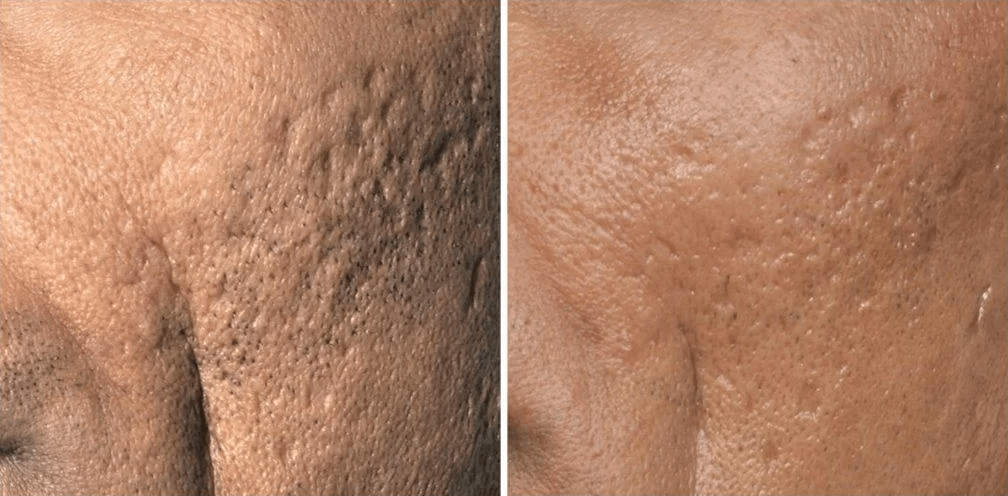 Acne scar revision and softening after two PicoSure Focus Laser treatments | EverYoung