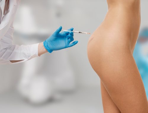Most Common FAQs on Nonsurgical Butt Lift Injections