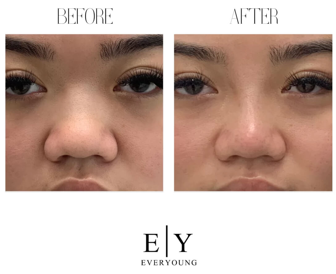 Surgical VS Non-Surgical Nose Jobs | EverYoung Skin Clinic Vancouver
