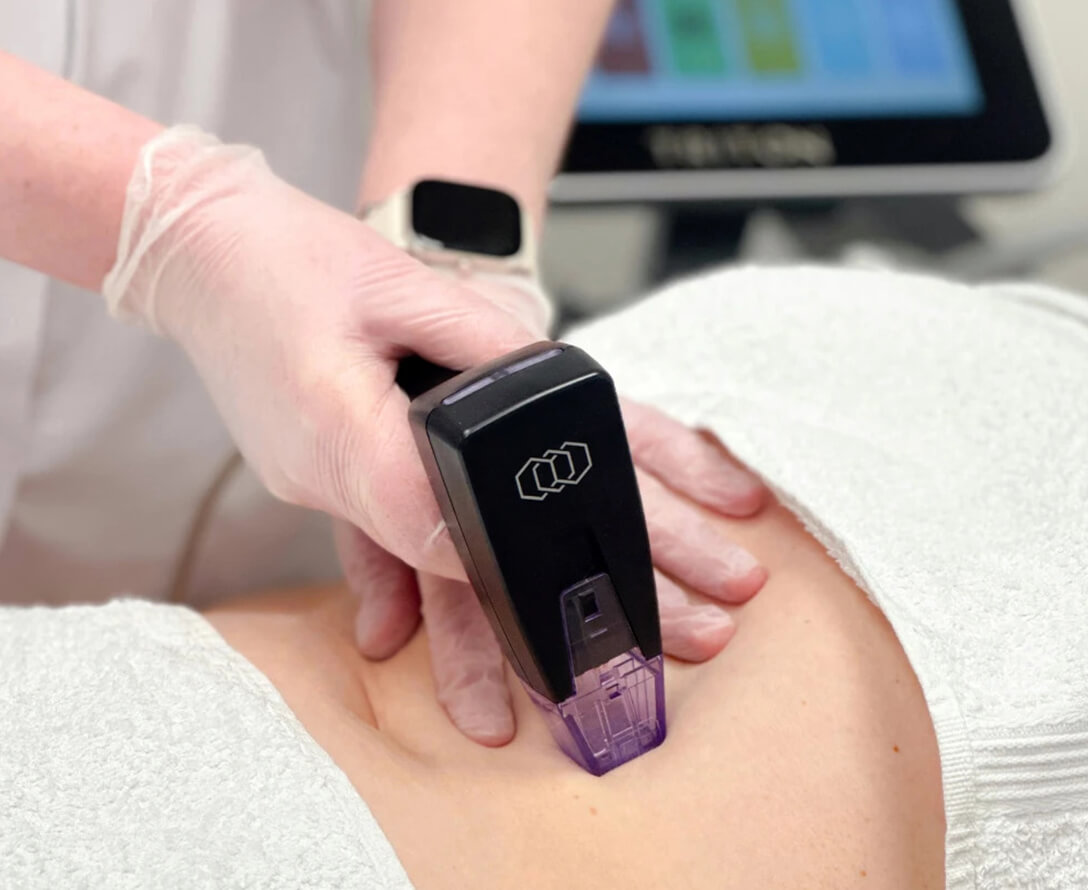 Sylfirm X vs. Morpheus8: Which Skin Treatment Should You Choose? | EverYoung Skin Care Clinic Vancouver