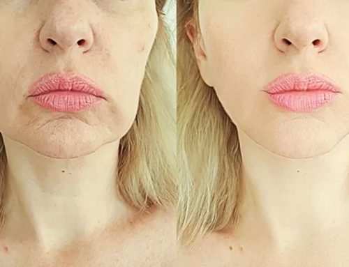 Thread Lift for Non-Surgical Facelifts
