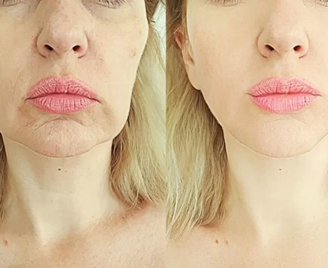 Thread Lift for Non Surgical Facelifts | EverYoung Skin Care Clinic Vancouver