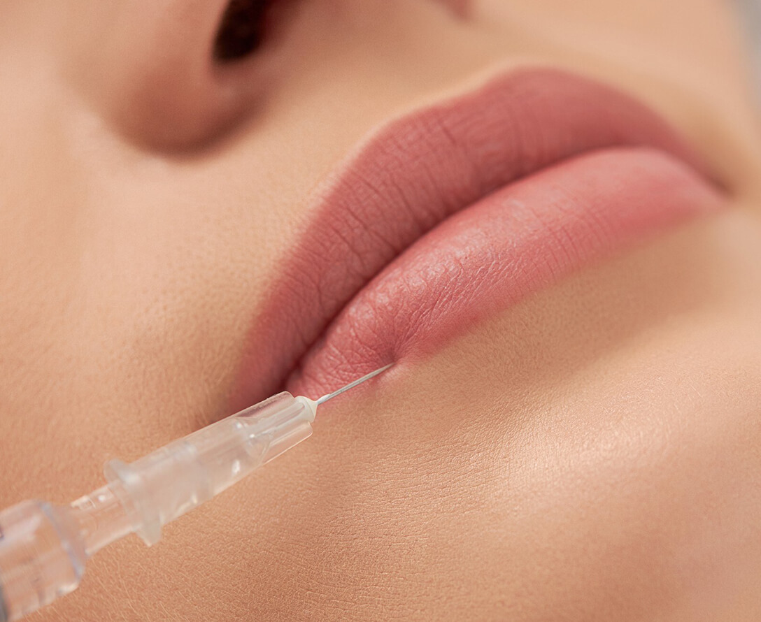 Types of Lip Filler Shapes & Which One is Right for You? | EverYoung Skin Care Clinic Vancouver
