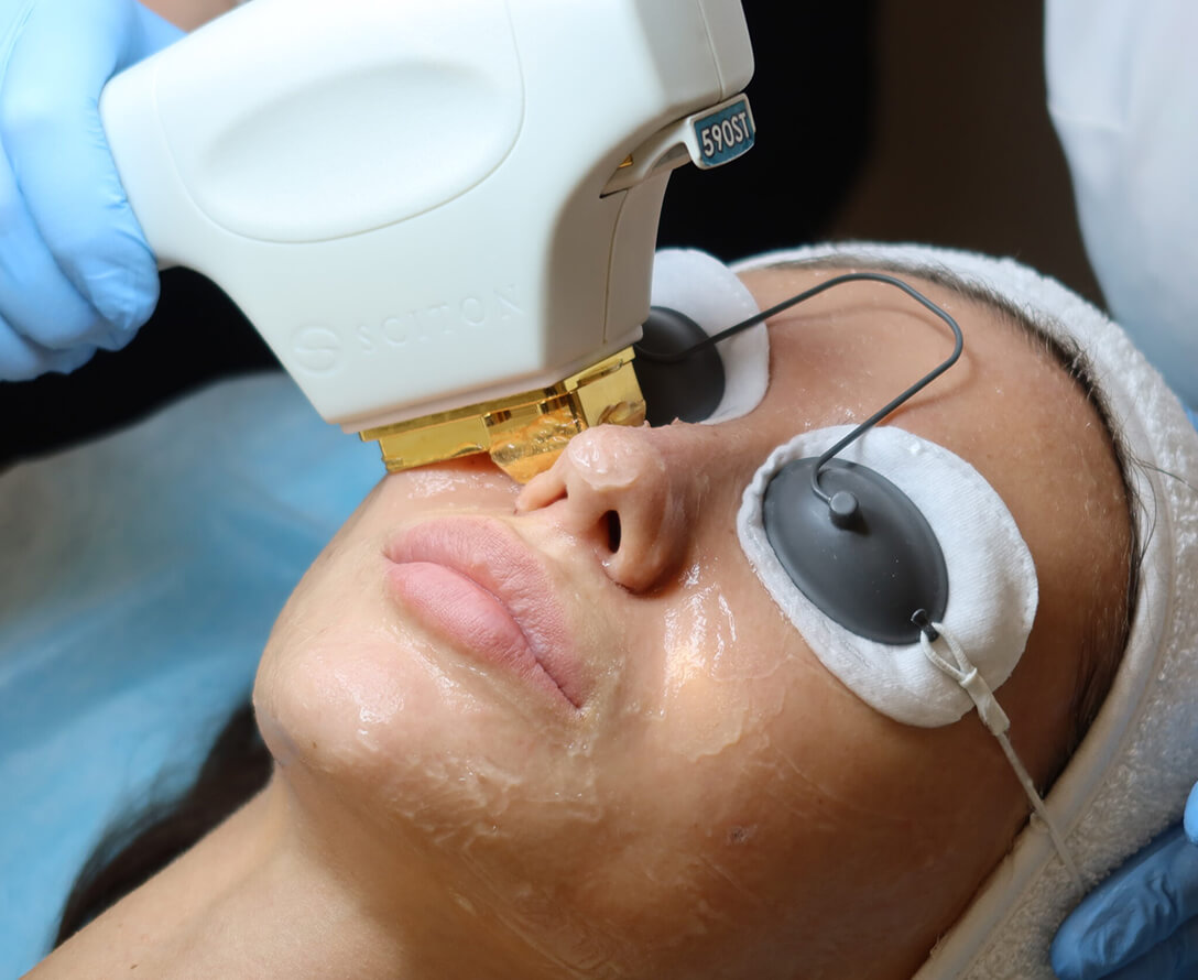 Differences Between BBL & IPL Treatments | EverYoung Skin Clinic Vancouver