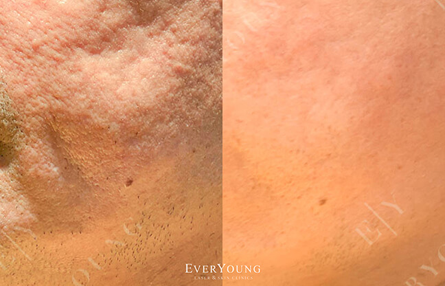 Acne Scar Treatment - Before & After - 2 | EverYoung Skin Care Clinic