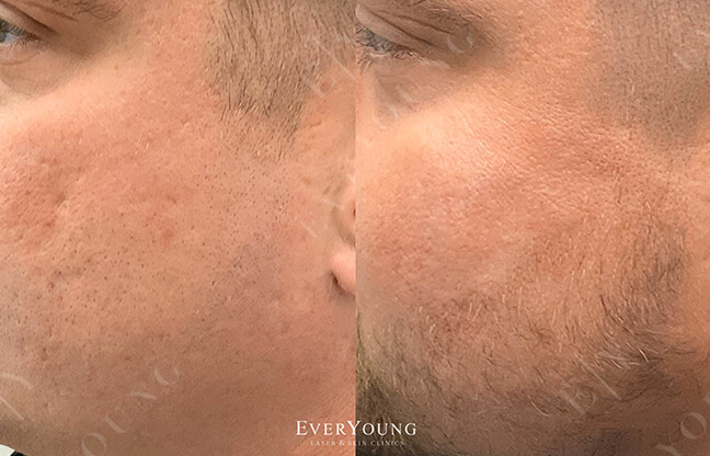 Acne Scar Treatment - Before & After - 1 | EverYoung Skin Care Clinic