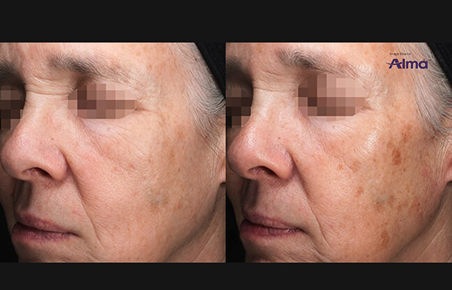 Alma Before & After - 1 | EverYoung Skin Clinic Vancouver