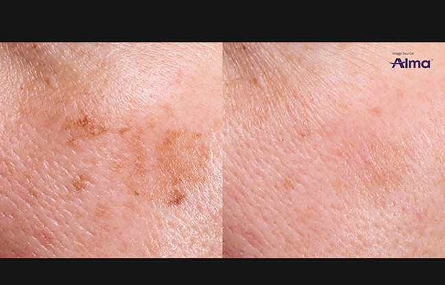 Alma Before & After - 2 | EverYoung Skin Clinic Vancouver