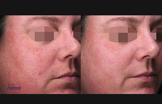 Alma Before & After - 3 | EverYoung Skin Clinic Vancouver