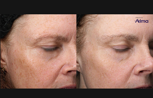 Alma Before & After - 4 | EverYoung Skin Clinic Vancouver