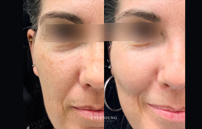 BBL Photo Facial Treatment - Before & After Results #1 | EverYoung Skin Clinic Vancouver