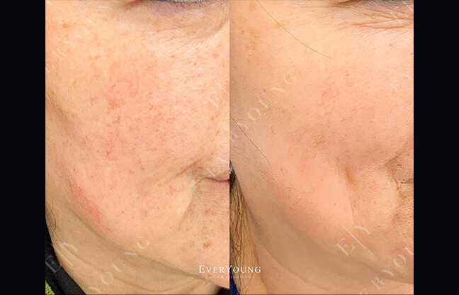 BBL Photo Facial Treatment - Before & After Results #2 | EverYoung Skin Clinic Vancouver