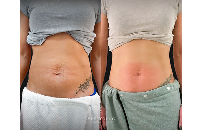 BodyFX™ Body Contouring Treatment - Before & After Results | EverYoung Skin Clinic Vancouver