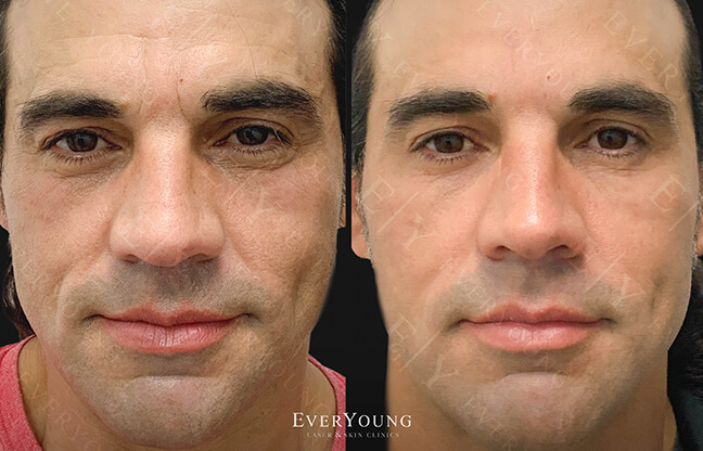 Botox Facial - Before & After - 2 | EverYoung Skin Clinic