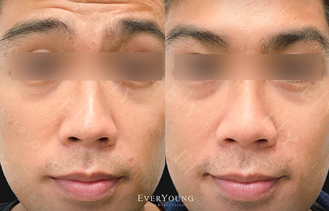 Botox Facial - Before & After - 3 | EverYoung Skin Clinic