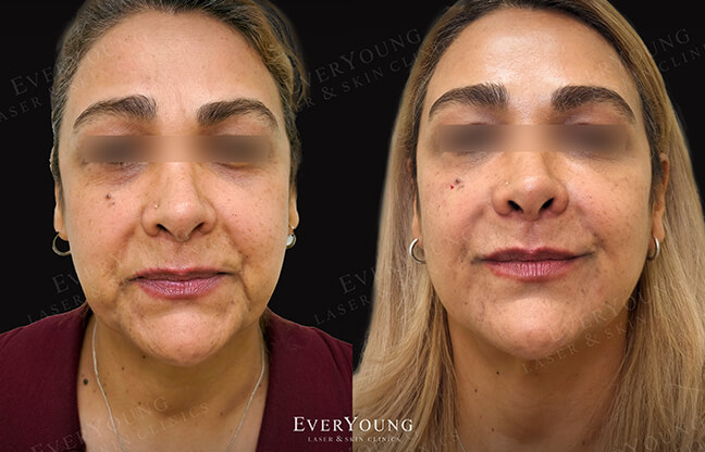 Botox Facial - Before & After - 1 | EverYoung Skin Clinic